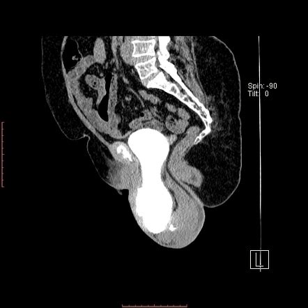 Pelvic Organ Prolapse Radiology Reference Article Radiopaedia Org
