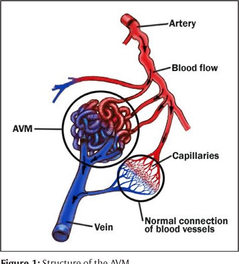 Figure From Arteriovenous Malformation Pulmonary Avm In A Post