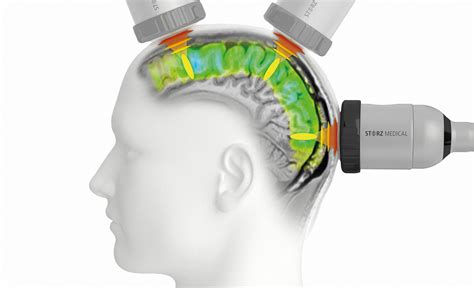 Parkinsons Disease Worlds First Clinical Trial For Shock Wave