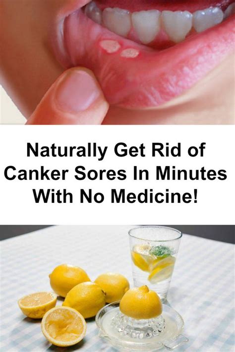 Canker Sores Inside The Mouth This Is How You Can Eliminate Them In