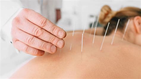 ims dry needling boost physiotherapy edmonton