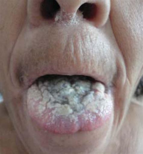 Fungus on lips treatment comes in many different forms and approach. 10 Types of Oral candidiasis Fungal infections you need to ...