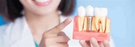Dental Implants Tips For Long Term Success Dr Motiwala Dental