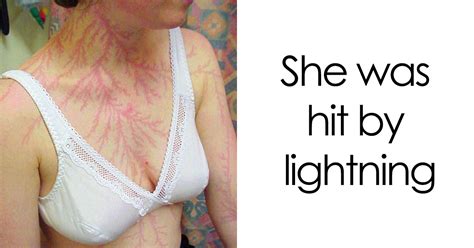 Photo Series Showing People Who Survived A Lightning Strike And What It Did To Their Skin Gloss