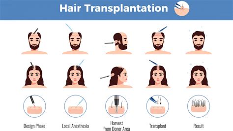 Pros And Cons Of Hair Transplantation Onlymyhealth