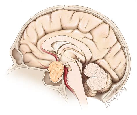 Pituitary Macroadenoma The Neurosurgical Atlas