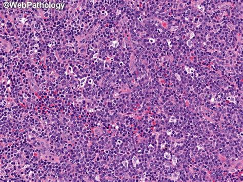The median survival period is reported to be between 1 to 2.5 years. Webpathology.com: A Collection of Surgical Pathology Images