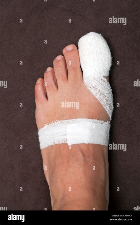 Big Toe Bandage After Surgery Stock Photo 51014447 Alamy
