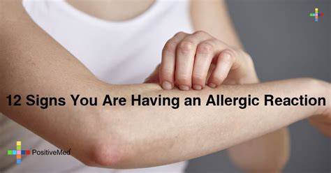 Signs You Are Having An Allergic Reaction Positivemed