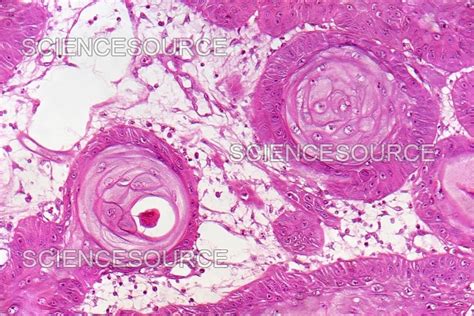 Esophageal Cancer Biopsy Epidermoid C Stock Image Science Source