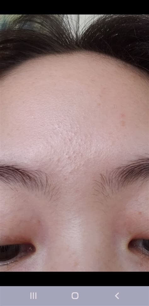 Routine Help Lol Pls Help How Can I Get Rid Of These Tiny Bumps In