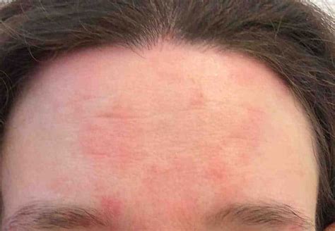 Laser Treatment Rosacea Facial Redness In Boca Raton Dermpartners