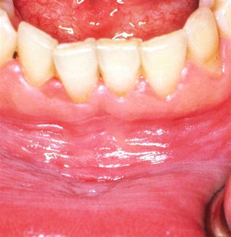 Swollen Gums Gums Gum Disease Receding Treat Periodontal Inflammation