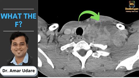 Virchows Nodes And Troisier Sign Radiology Capsule Radiogyan