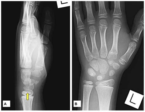 Congenital bipartite lunate presenting as a misdiagnosed ...