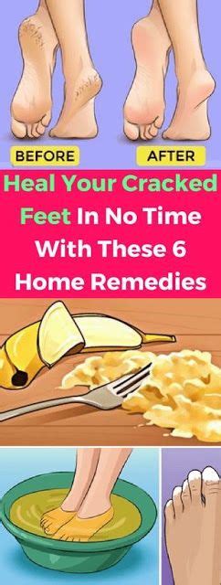 Heal Your Cracked Feet In No Time With These 6 Home Remedies Cracked Feet Home Remedies