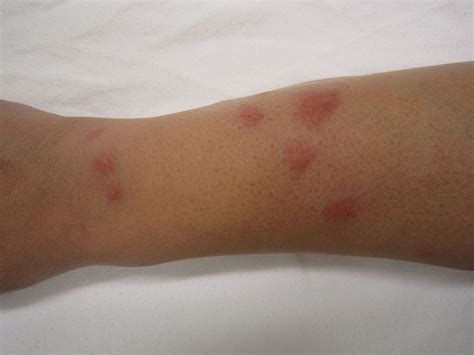 Bed Bugs Rash Symptoms Treatment Edited