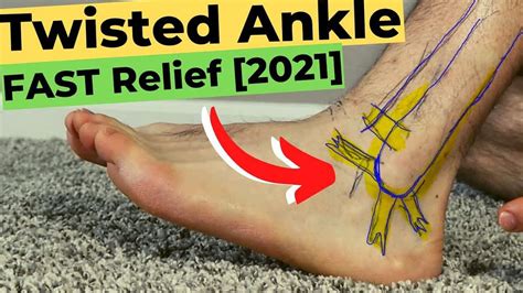 Can I Walk On A Sprained Ankle Rolled Ankle Twisted Ankle Sprain