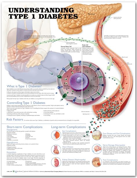 Anatomy Of Diabetes Type 1 - Diabetes Poster