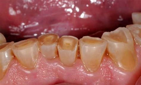 Desgaste Dental Afecta Cientos De Adultos Mayores