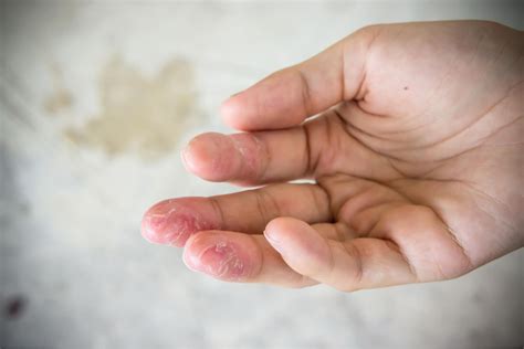 Contact Dermatitis Hands