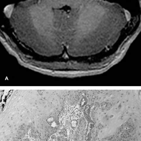 A Axial T1w Mri Image With Gadolinium Contrast Demonstrating Bilateral