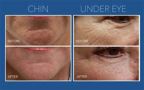 Micro Needling With Prp Skin Rejuvenation Rochester Ny