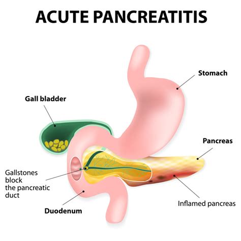 Vitamin K Relief For Acute Pancreatitis