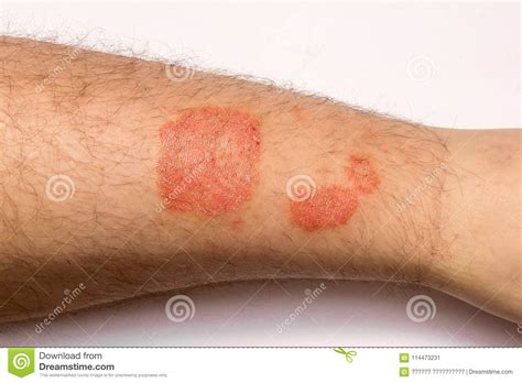 Psoriasis Skin Disease Stock Photo 93260718