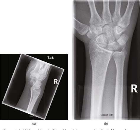 Figure 1 From Dual Intra Articular Fracture Of The Body And Hook Of