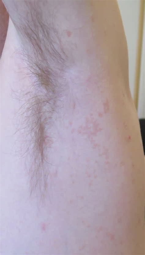 Pityriasis Versicolor Pictures Symptoms And Treatment