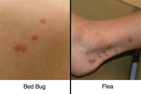 Bed Bug Bites Vs Flea Bites Quickly Tell The Difference