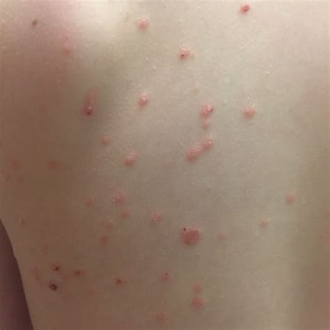 Which Infection Preceded This Cutaneous Eruption Amsa