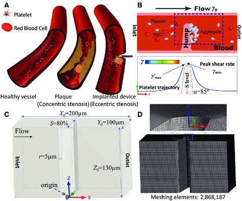 Schematics Of Vessel Stenosis And The Mimicking Microfluidic Models Of
