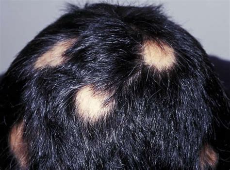 However, excessive shedding, hair loss leading to bald patches and fur that falls out in clumps as part of grooming or brushing is not normal identifying feline alopecia. Thinning Hair and Itchy Scalp