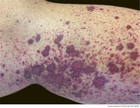 Leukocytoclastic Vasculitis After Exposure To Covid 19 Vaccine Anais