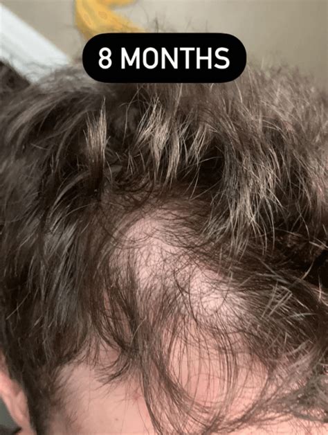Before And After Photos Of Hair Transplant Surgeries What Success And