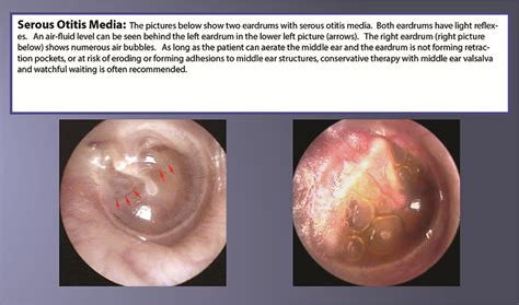 Serous Otitis Media And Acute Otitis Media