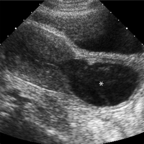 Hematocolpos Longitudinal Image From A Transabdominal Pelvic Sonogram