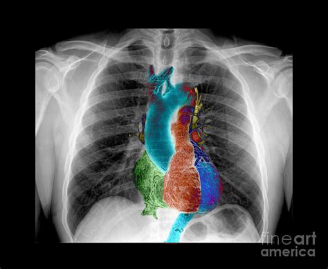 X Ray Of Chest And Heart Photograph By Living Art Enterprises Pixels