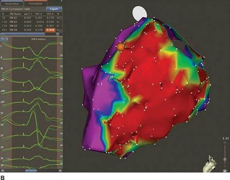 Carto Map Of Slow Pathway Ablation