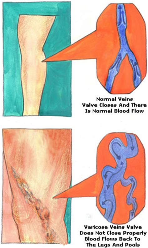 Home Remedies For Varicose Veins Causes Symptoms