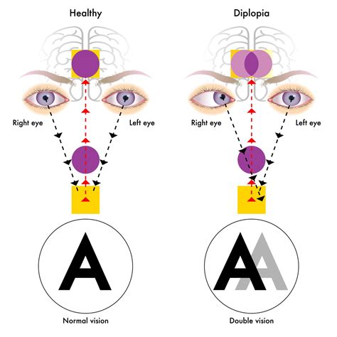 Prism Glasses For Double Vision Diplopia