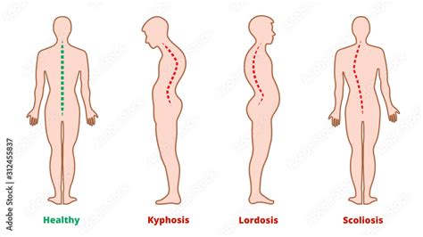 Diseases Of The Spine Scoliosis Lordosis Kyphosis Body Posture