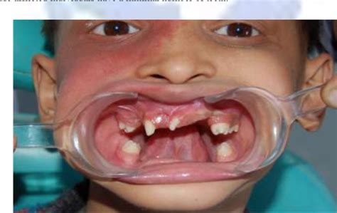 Figure From Anhidrotic Ectodermal Dysplasia The Dental Perspective