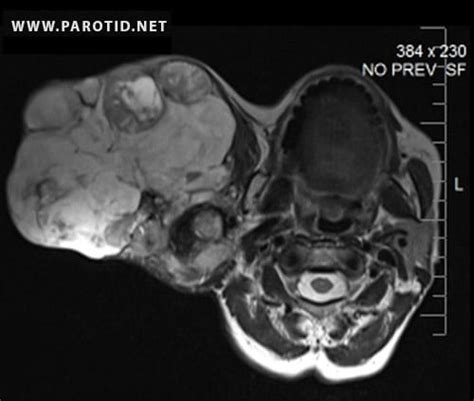 Parotid Gland Tumor Pictures For Surgery
