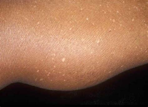 White Spots Skin Problem You Should Know Healthy Web Md