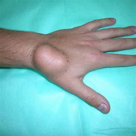 8 Retrieval Of Lipoma Located Deep In The Hand Download Scientific