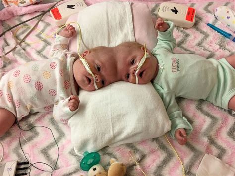Twins Who Survived One Of The Rarest Separation Surgeries In The World