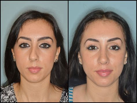 Dr Anthony Bared Shares Tips For Choosing A Rhinoplasty Surgeon
